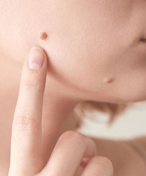 WarzenOff Creme zur sofortigen Entfernung von Hautunreinheiten