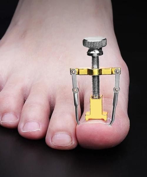 Fixiergerät für eingewachsene Zehennägel